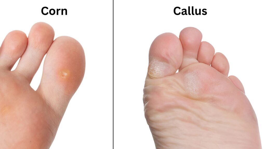 Corn 和 Callus的区别